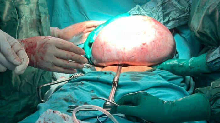 Trabzon`da 83 yaşındaki kadından 10 kiloluk tümör çıkarıldı